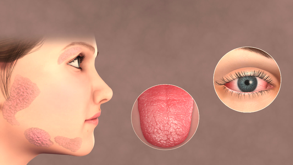 Sjogrenovsindrom.jpg
